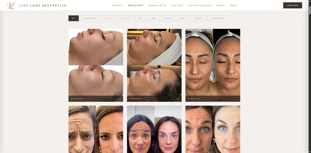 The Before & After gallery: a row of treatment filter buttons — All, Neurotoxin, Lily Lip, Lily Lift, PRF, NSNJ, Laser, Peels, SkinPen and HydraFacial — above a three-column grid of paired result photographs, each labelled with its treatment.